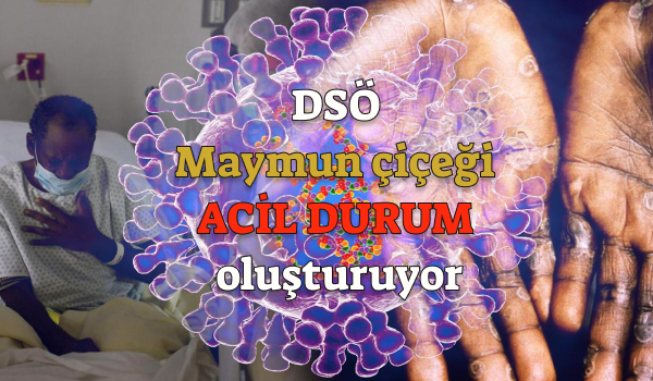 DSÖ: Maymun çiçeği uluslararası önem arz eden bir halk sağlığı acil durumu oluşturuyor